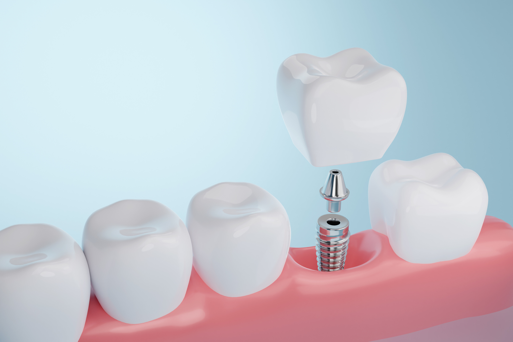 cómo se pone un implante dental