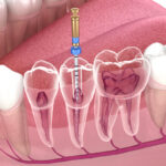 qué es una endodoncia
